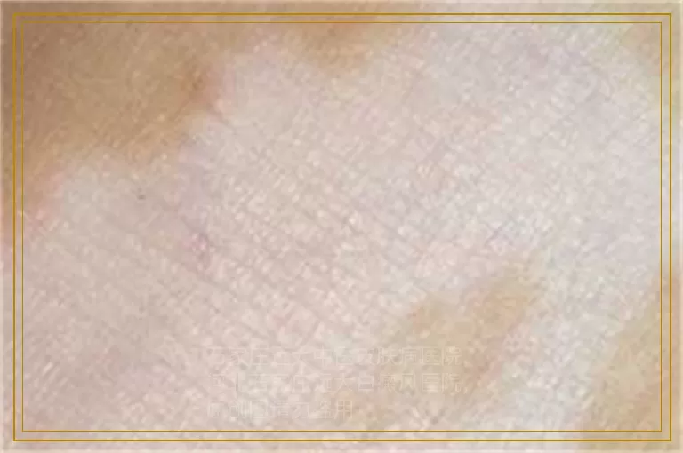 三维皮肤CT检查早期白癜风准不准