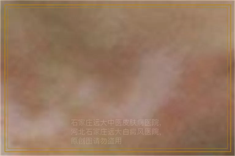 检查白斑做皮肤CT多少钱