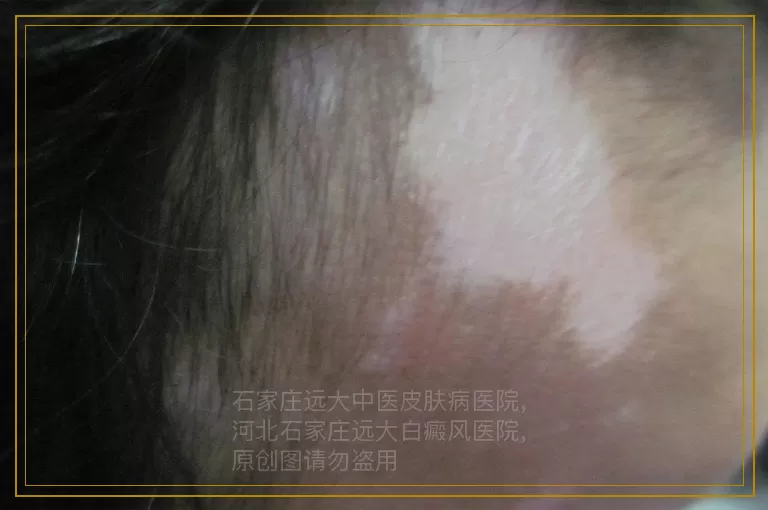 白癜风检查哪些是重点?