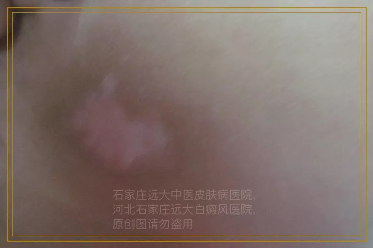 身上长白斑做检查多少钱