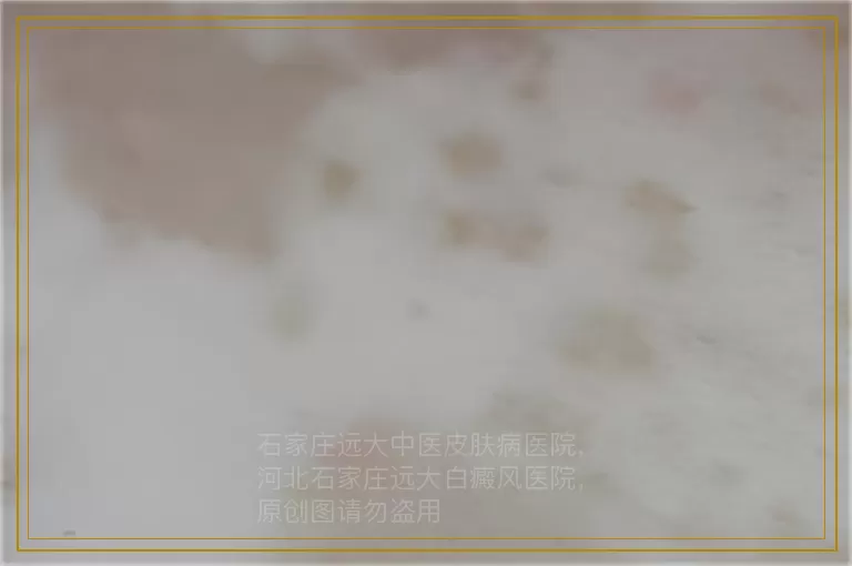 诊断白斑是不是白癜风的方式