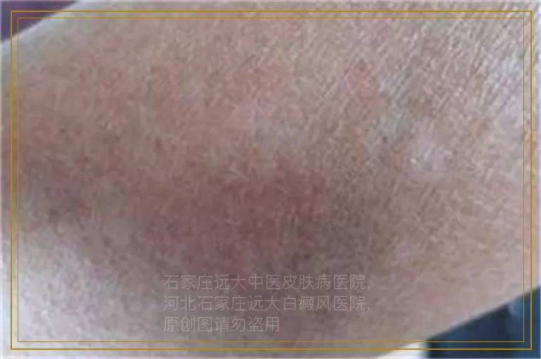 伍德灯检查正常还会是白癜风吗