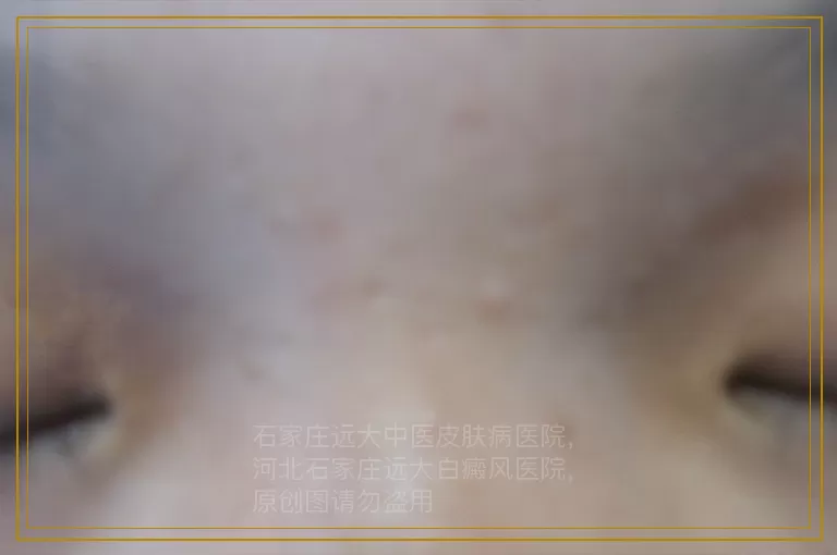 伍德灯检查灰白色会是白癜风吗