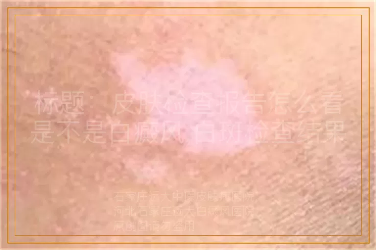 标题：皮肤检查报告怎么看是不是白癜风,白斑检查结果如何确认白癜风,怎么通过检查确认是不是白癜风