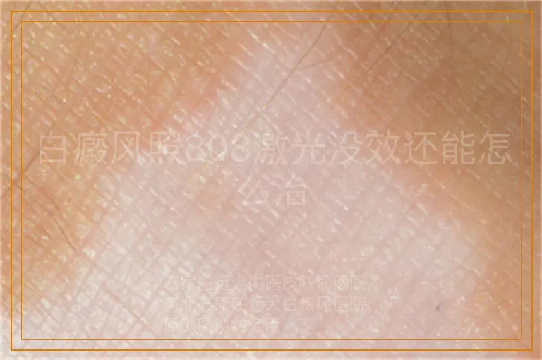 白癜风照308激光没效还能怎么治