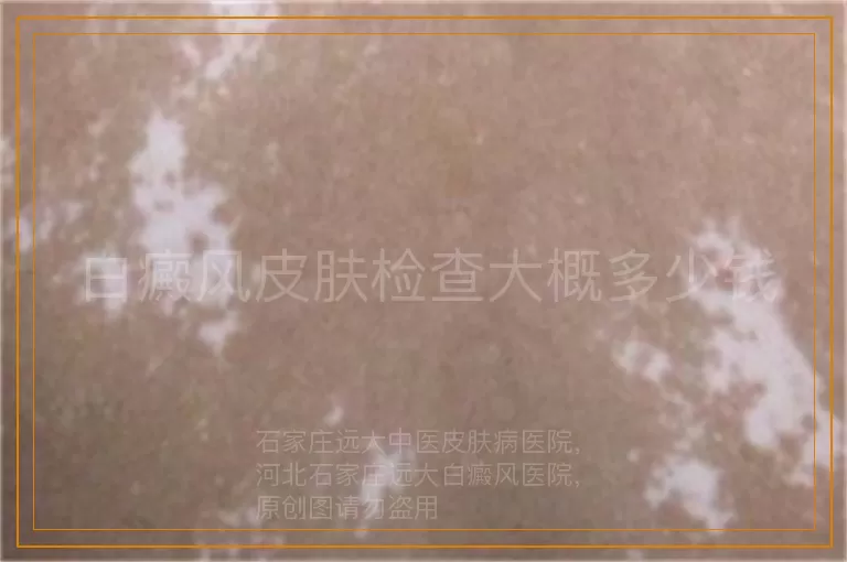 白癜风皮肤检查大概多少钱