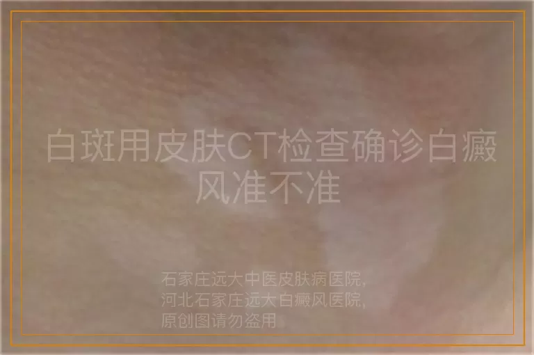 白斑用皮肤CT检查确诊白癜风准不准