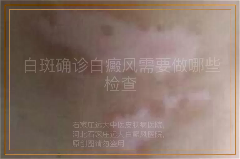 白斑确诊白癜风需要做哪些检查