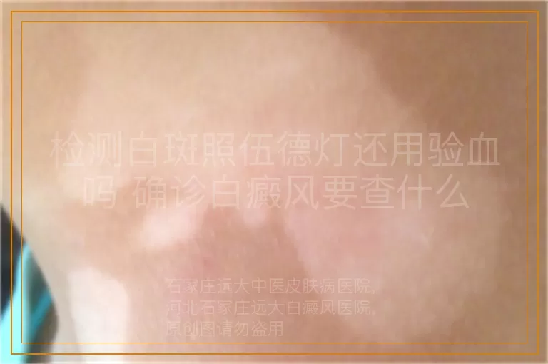检测白斑照伍德灯还用验血吗 确诊白癜风要查什么