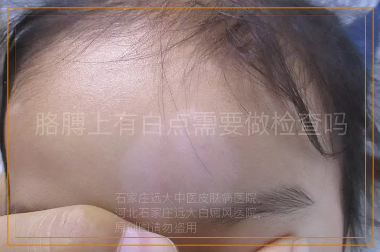 胳膊上有白点需要做检查吗