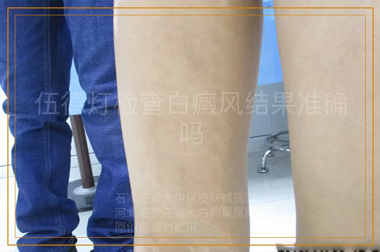 伍德灯检查白癜风结果准确吗