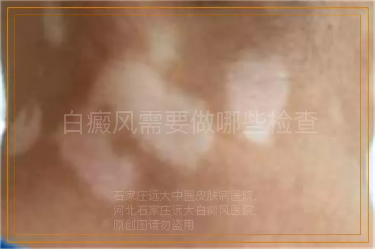 白癜风需要做哪些检查