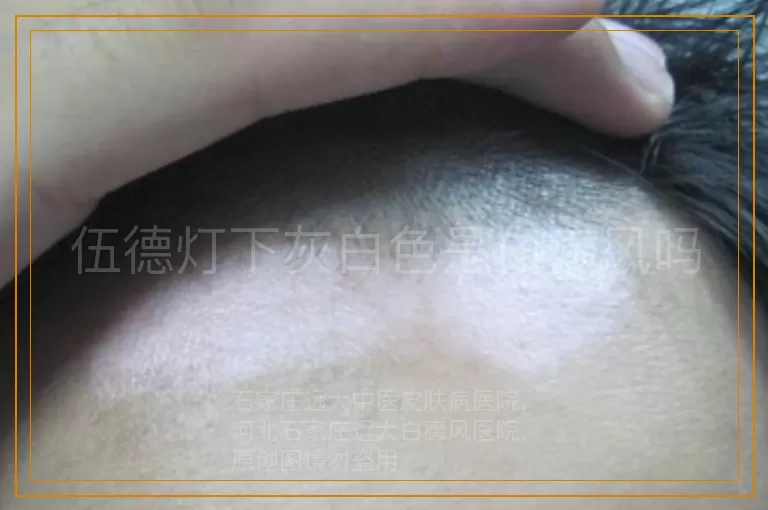 伍德灯下灰白色是白癜风吗