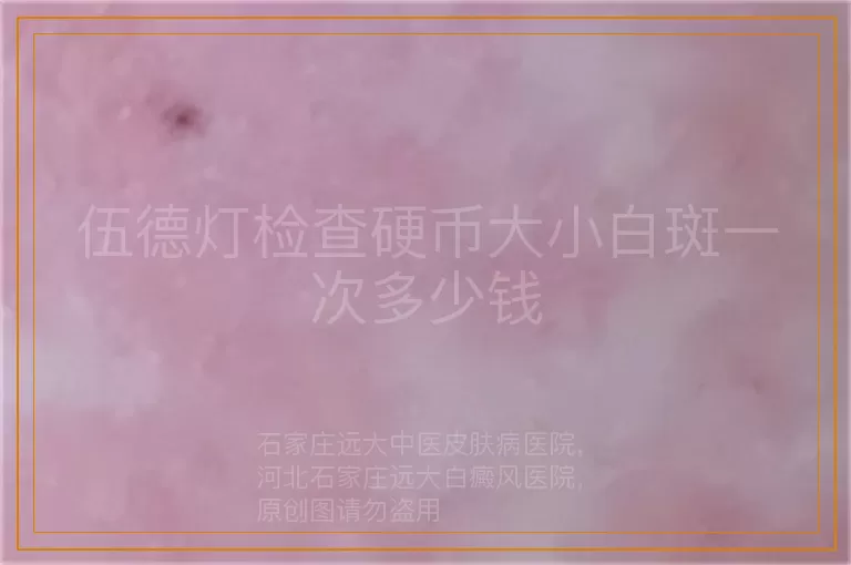 伍德灯检查硬币大小白斑一次多少钱