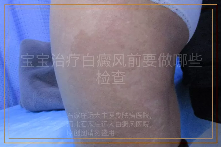 宝宝治疗白癜风前要做哪些检查