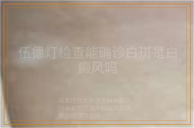 伍德灯检查能确诊白斑是白癜风吗