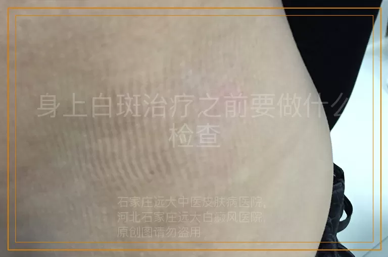 身上白斑治疗之前要做什么检查