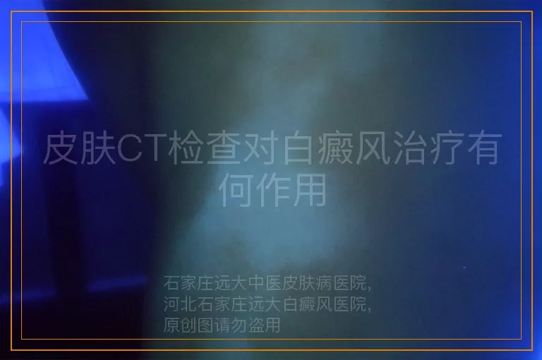 皮肤CT检查对白癜风治疗有何作用