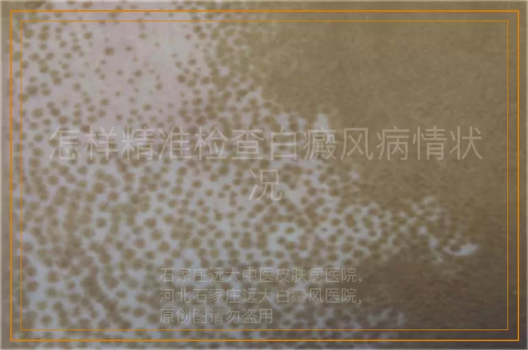 怎样精准检查白癜风病情状况