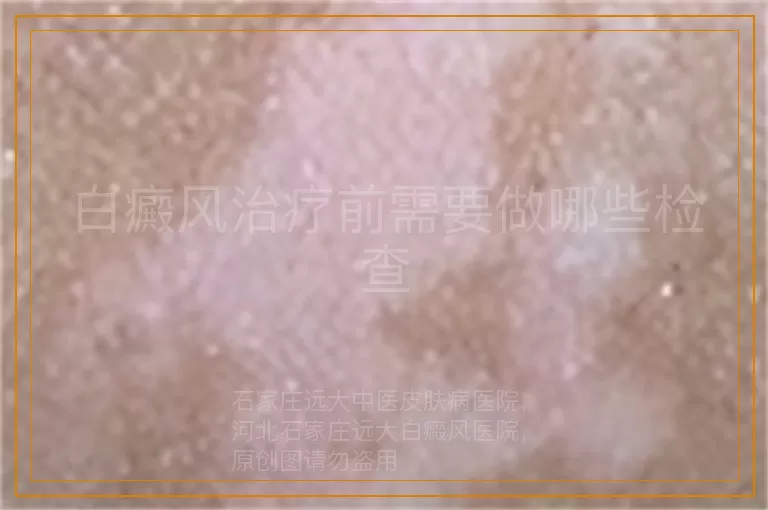 白癜风治疗前需要做哪些检查