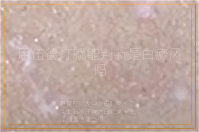 用伍德灯就能判断是白癜风吗