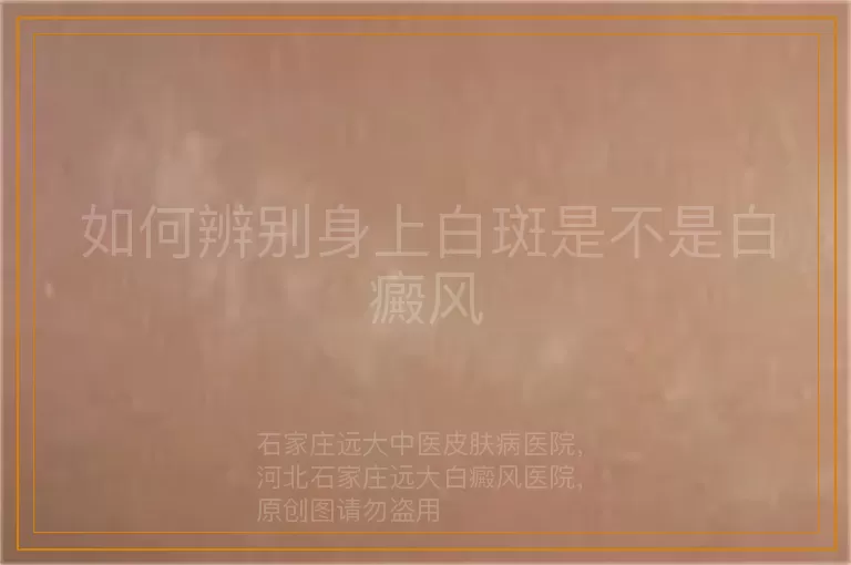 如何辨别身上白斑是不是白癜风