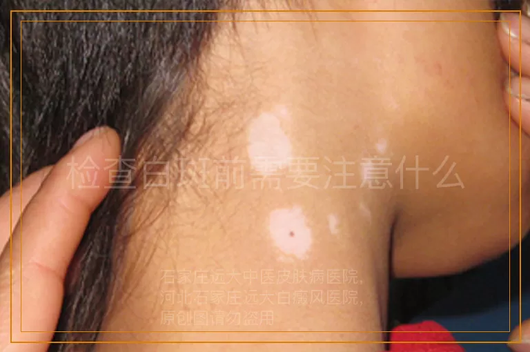 检查白斑前需要注意什么
