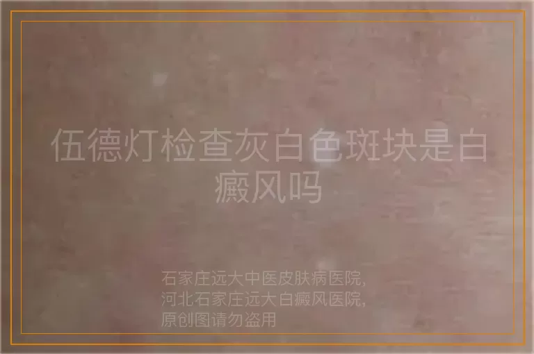 伍德灯检查灰白色斑块是白癜风吗