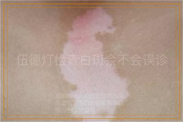 伍德灯检查白斑会不会误诊