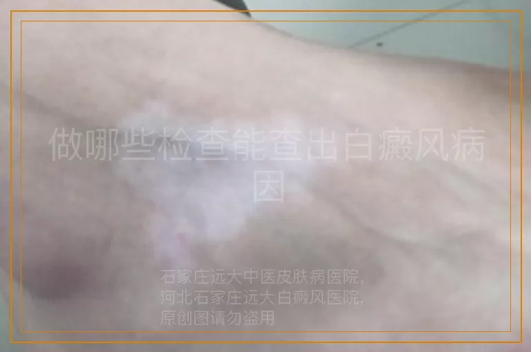 做哪些检查能查出白癜风病因