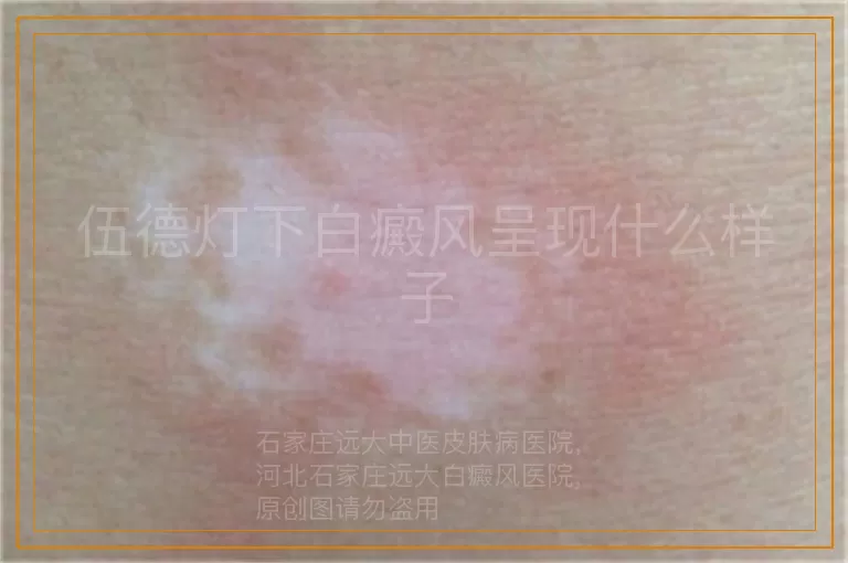 伍德灯下白癜风呈现什么样子