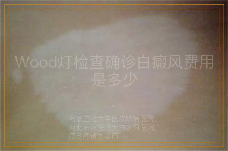 Wood灯检查确诊白癜风费用是多少