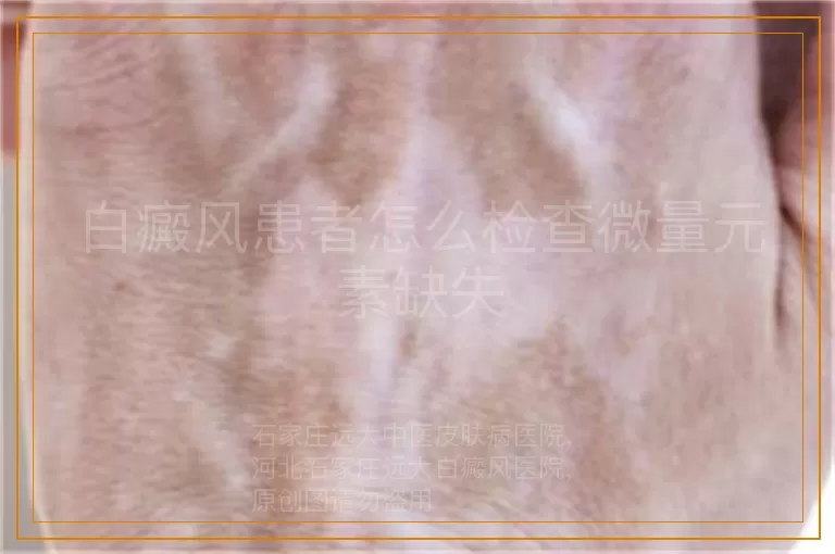 白癜风患者怎么检查微量元素缺失