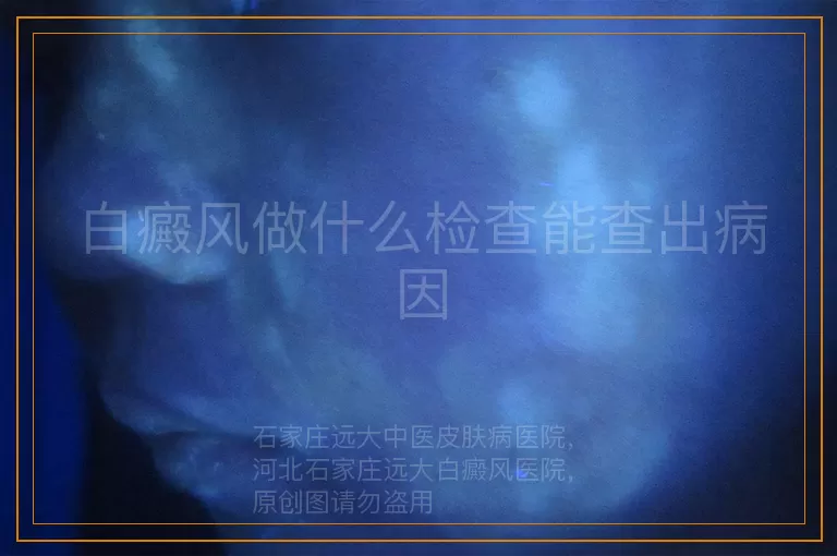 白癜风做什么检查能查出病因