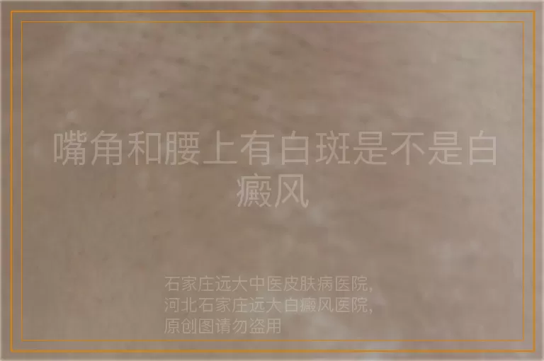 嘴角和腰上有白斑是不是白癜风