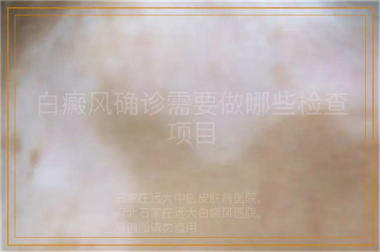 白癜风确诊需要做哪些检查项目