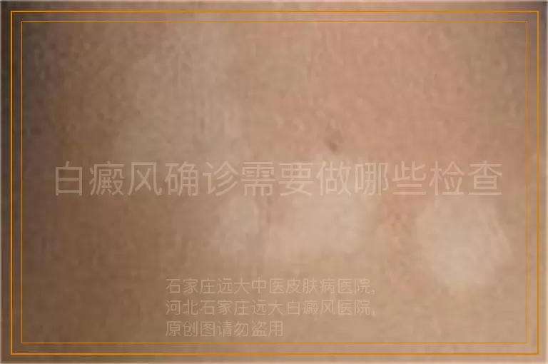 白癜风确诊需要做哪些检查