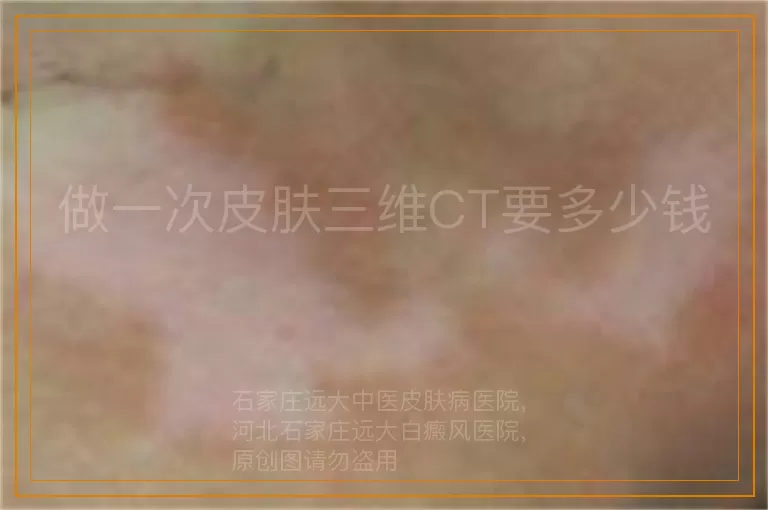 做一次皮肤三维CT要多少钱