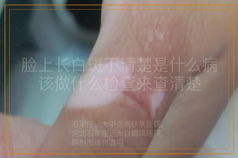 脸上长白斑不清楚是什么病该做什么检查来查清楚