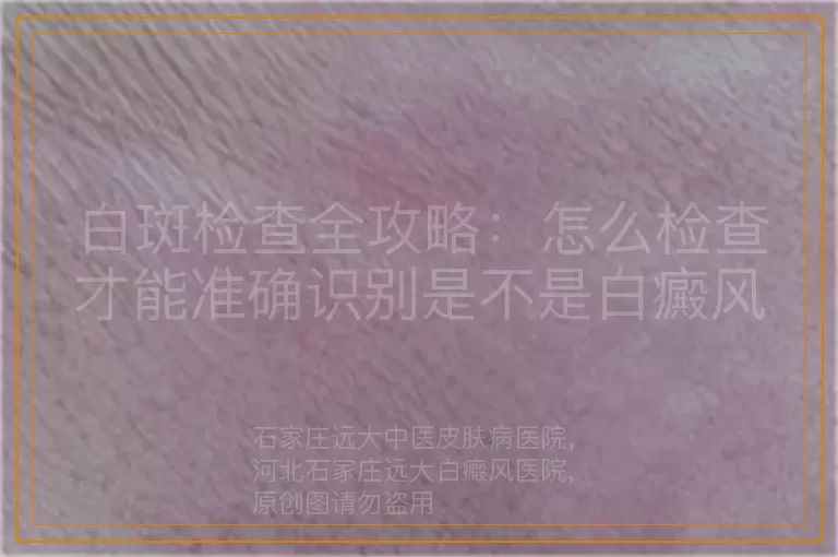 白斑检查全攻略：怎么检查才能准确识别是不是白癜风