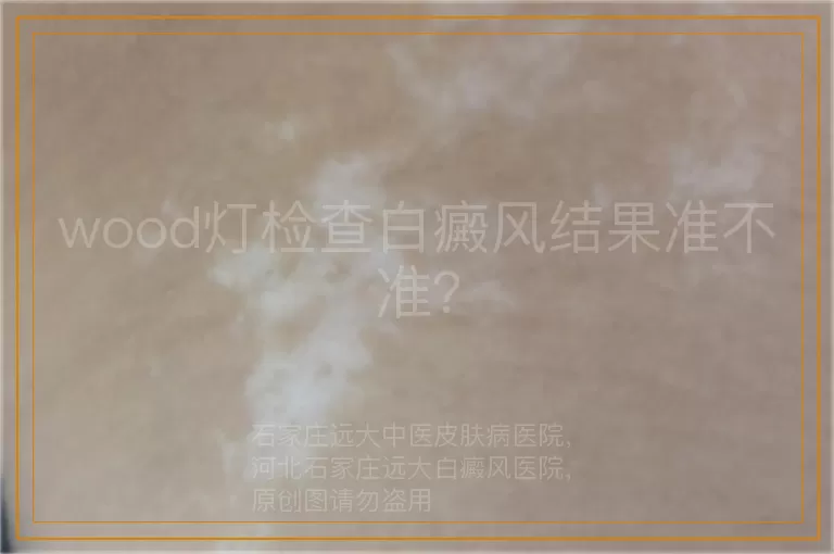 wood灯检查白癜风结果准不准？