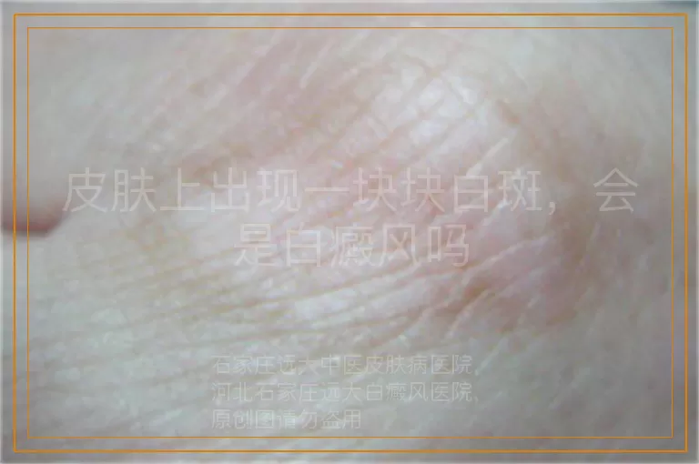 皮肤上出现一块块白斑，会是白癜风吗