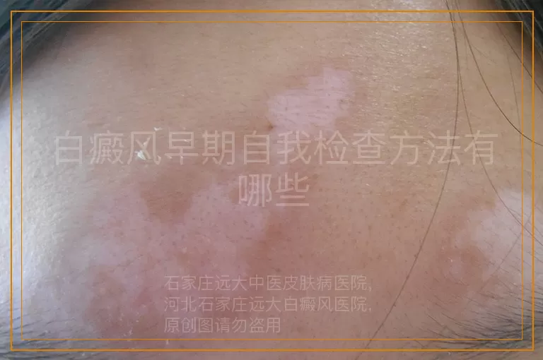 白癜风早期自我检查方法有哪些
