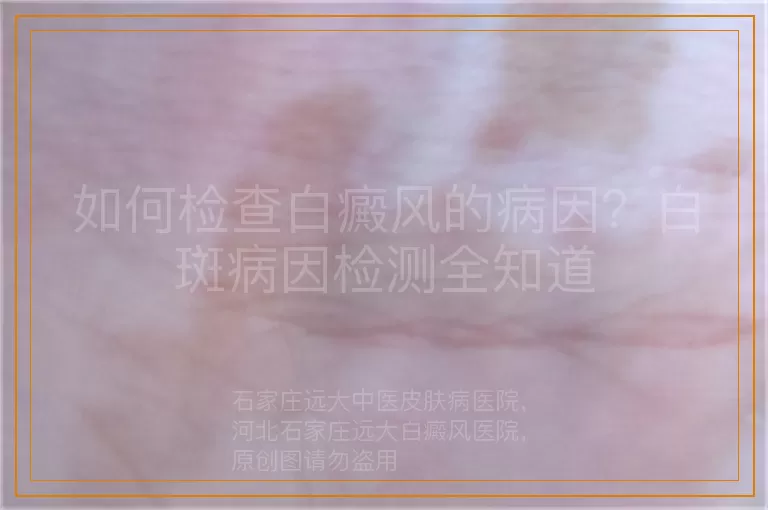 如何检查白癜风的病因？白斑病因检测全知道