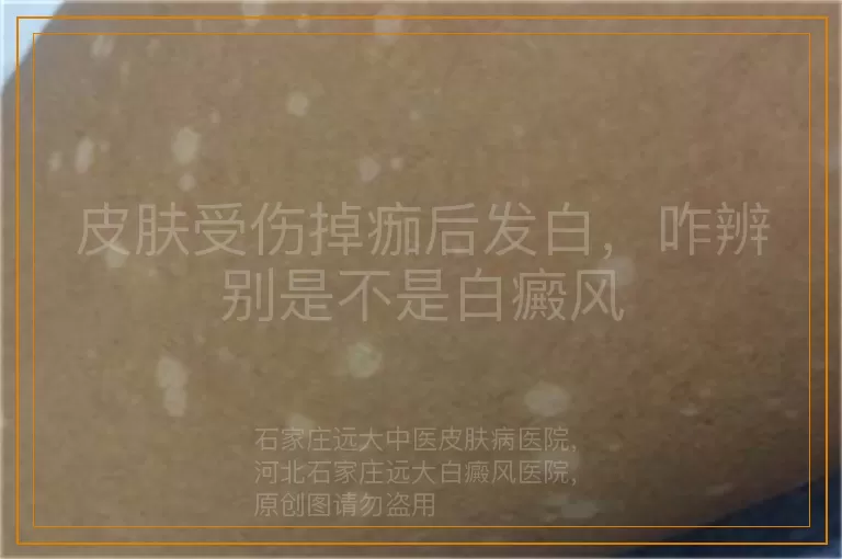 皮肤受伤掉痂后发白，咋辨别是不是白癜风
