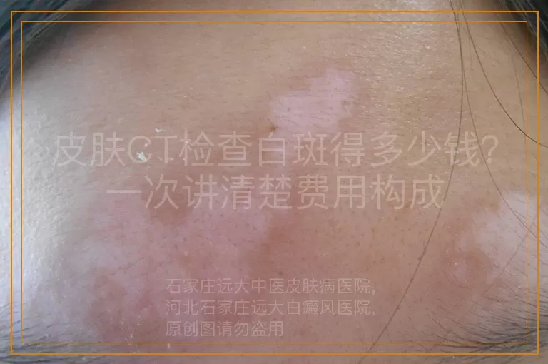 皮肤CT检查白斑得多少钱？一次讲清楚费用构成