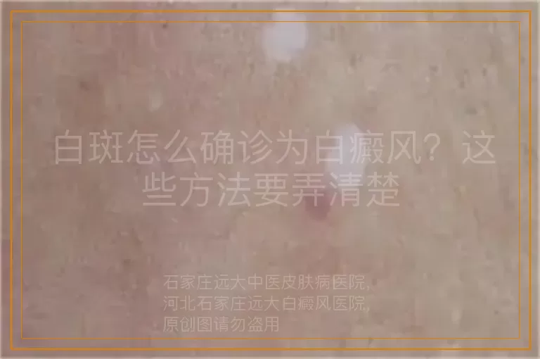 白斑怎么确诊为白癜风？这些方法要弄清楚