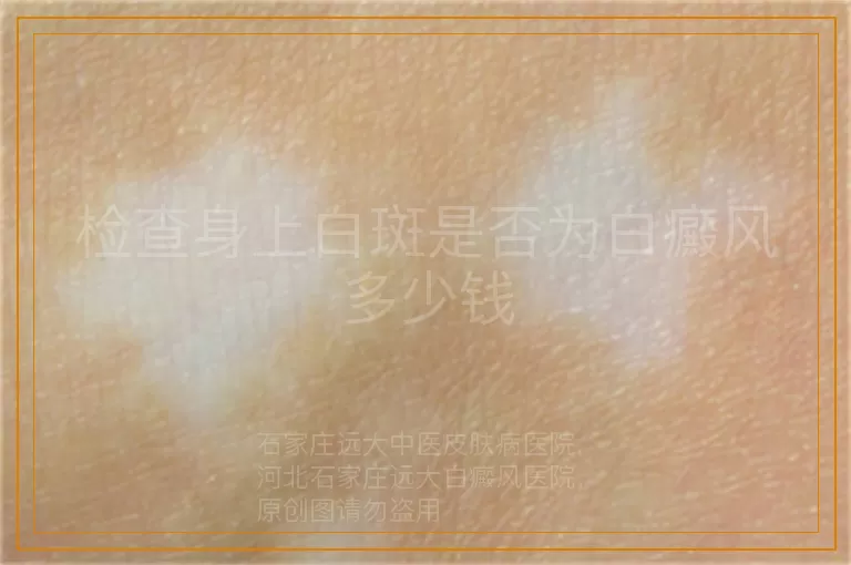 检查身上白斑是否为白癜风多少钱