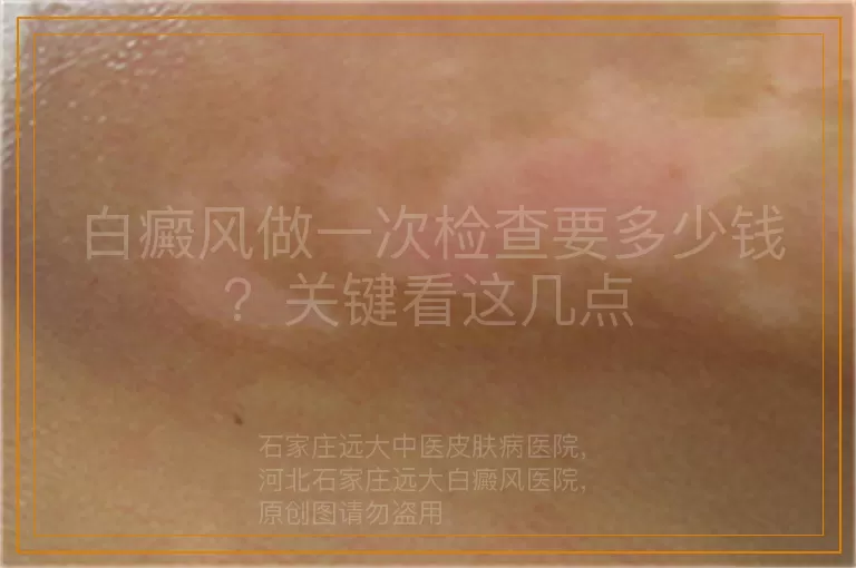 白癜风做一次检查要多少钱？关键看这几点