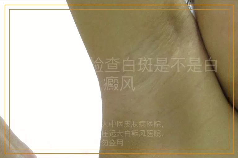 如何精准检查白斑是不是白癜风